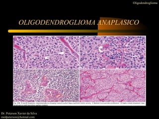 OLIGODENDROGLIOMA ANAPLASICO
Oligodendroglioma
Dr. Peterson Xavier da Silva
medpeterson@hotmal.com
 