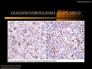OLIGODENDROGLIOMA ANAPLASICO
Oligodendroglioma
Dr. Peterson Xavier da Silva
medpeterson@hotmal.com
 
