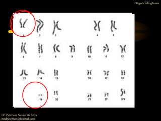 Oligodendroglioma
Etiologia
Dr. Peterson Xavier da Silva
medpeterson@hotmal.com
 