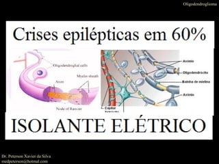 Dr. Peterson Xavier da Silva
medpeterson@hotmal.com
Oligodendroglioma
 