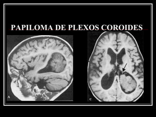 PAPILOMA DE PLEXOS COROIDES 