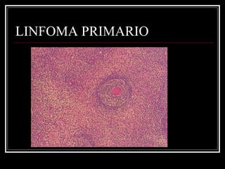 LINFOMA PRIMARIO 