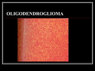 OLIGODENDROGLIOMA 
