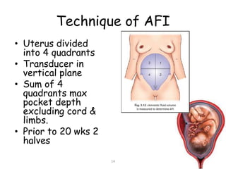Technique of AFI
• Uterus divided
into 4 quadrants
• Transducer in
vertical plane
• Sum of 4
quadrants max
pocket depth
excluding cord &
limbs.
• Prior to 20 wks 2
halves
14
 