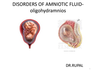 DISORDERS OF AMNIOTIC FLUID-
oligohydramnios
DR.RUPAL
1
 