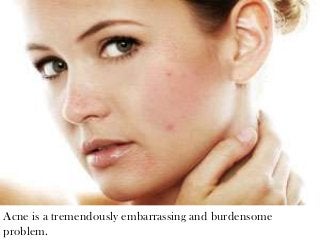 Acne is a tremendously embarrassing and burdensome
problem.
 