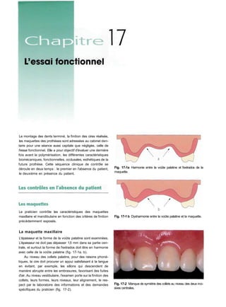 Le praticien contrôle les caractéristiques des maquettes
maxillaire et mandibulaire en fonction des critères de finition
précédemment exposés.
La maquette maxillaire
L'épaisseur et la forme de la voûte palatine sont examinées.
L'épaisseur ne doit pas dépasser 1,5 mm dans sa partie cen-
trale, et surtout la forme de l'extrados doit être en harmonie
avec celle de la voûte palatine (fig. 17-1a, b).
Au niveau des collets palatins, pour des raisons phoné-
tiques, la cire doit procurer un appui satisfaisant à la langue
en évitant, par exemple, les sillons qui descendent de
manière abrupte entre les embrasures, favorisant des fuites
d'air. Au niveau vestibulaire, l'examen porte sur la finition des
collets, leurs formes, leurs niveaux, leur alignement, le res-
pect par le laboratoire des informations et des demandes
spécifiques du praticien (fig. 17-2).
Fig. 17-1 b Dysharmonie entre la voûte palatine et la maquette.
Fig. 17-2 Manque de symétrie des collets au niveau des deux inci-
sives centrales.
Le montage des dents terminé, la finition des cires réalisée,
les maquettes des prothèses sont adressées au cabinet den-
taire pour une séance aussi capitale que négligée, celle de
l'essai fonctionnel. Elle a pour objectif d'évaluer une dernière
fois avant la polymérisation, les différentes caractéristiques
biomécaniques, fonctionnelles, occlusales, esthétiques de la
future prothèse. Cette séquence clinique de contrôle se
déroule en deux temps : le premier en l'absence du patient,
le deuxième en présence du patient.
Fig. 17-1a Harmonie entre la voûte palatine et l'extrados de la
maquette.
 