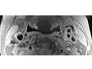 071 carotid array coil