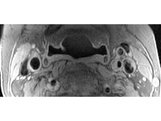 071 carotid array coil