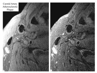 Carotid Artery
Atherosclerotic
Plaque
 