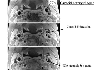 Carotid artery plaqueCCA
Carotid bifurcation
ICA stenosis & plaque
 