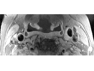 071 carotid array coil