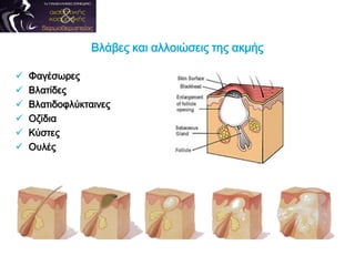 Βλάβες και αλλοιώσεις της ακμής
 Φαγέσωρες
 Βλατίδες
 Βλατιδοφλύκταινες
 Οζίδια
 Κύστες
 Ουλές
 