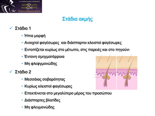 Στάδια ακμής
 Στάδιο 1
• Ήπια μορφή
• Ανοιχτοί φαγέσωρες και διάσπαρτοι κλειστοί φαγέσωρες
• Εντοπίζεται κυρίως στο μέτωπο, στις παρειές και στο πηγούνι
• Έντονη σμηγματόρροια
• Μη φλεφγμονώδης
 Στάδιο 2
• Μεσσάιας σοβαρότητας
• Κυρίως κλειστοί φαγέσωρες
• Επεκτέινεται στο μεγαλύτερο μέρος του προσώπου
• Διάσπαρτες βλατίδες
• Μη φλεγμονώδης
 