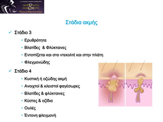 Στάδια ακμής
 Στάδιο 3
• Ερυθρότητα
• Βλατίδες & Φλύκταινες
• Εντοπίζεται και στο ντεκολτέ και στην πλάτη
• Φλεγμονώδης
 Στάδιο 4
• Κυστική ή οζώδης ακμή
• Ανοιχτοί & κλειστοί φαγέσωρες
• Βλατίδες & φλύκταινες
• Κύστες & οζίδια
• Ουλές
• Έντονη φλεγμονή
 