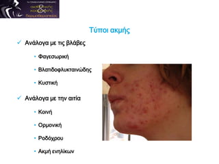 Τύποι ακμής
 Ανάλογα με τις βλάβες
• Φαγεσωρική
• Βλατιδοφλυκταινώδης
• Κυστική
 Ανάλογα με την αιτία
• Κοινή
• Ορμονική
• Ροδόχρου
• Ακμή ενηλίκων
 