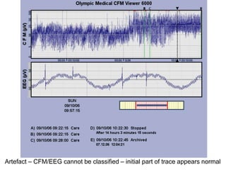 Artefact – CFM/EEG cannot be classified – initial part of trace appears normal
 