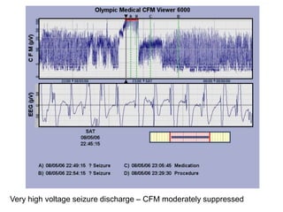 Very high voltage seizure discharge – CFM moderately suppressed
 