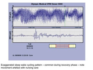 Exaggerated sleep wake cycling pattern – common during recovery phase – note
movement artefact with nursing care
 