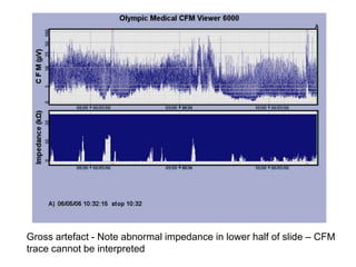 Gross artefact - Note abnormal impedance in lower half of slide – CFM
trace cannot be interpreted
 