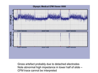 Gross artefact probably due to detached electrodes
Note abnormal high impedance in lower half of slide –
CFM trace cannot be interpreted
 