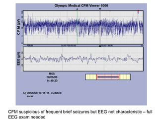 CFM suspicious of frequent brief seizures but EEG not characteristic – full
EEG exam needed
 