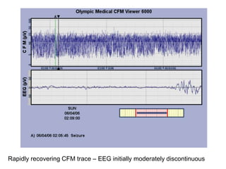 Rapidly recovering CFM trace – EEG initially moderately discontinuous
 