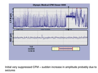 Initial very suppressed CFM – sudden increase in amplitude probably due to
seizures
 
