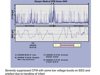 Severely suppressed CFM with some low voltage bursts on EEG and
artefact due to handling of infant
 