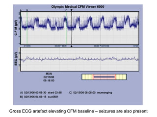 Gross ECG artefact elevating CFM baseline – seizures are also present
 