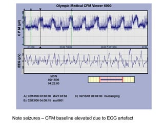 Note seizures – CFM baseline elevated due to ECG artefact
 
