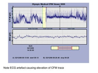 Note ECG artefact causing elevation of CFM trace
 