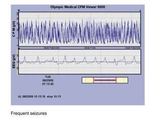 Frequent seizures
 