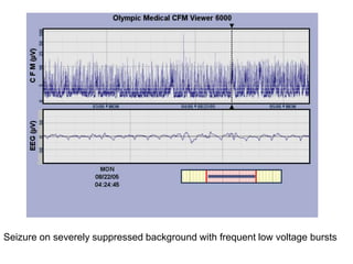 Seizure on severely suppressed background with frequent low voltage bursts
 