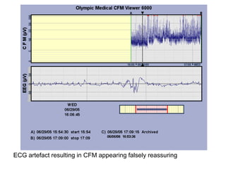 ECG artefact resulting in CFM appearing falsely reassuring
 