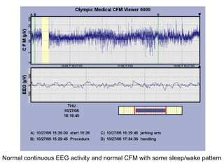 Normal continuous EEG activity and normal CFM with some sleep/wake pattern
 