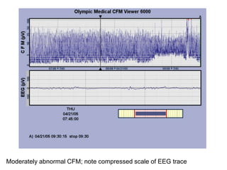 Moderately abnormal CFM; note compressed scale of EEG trace
 