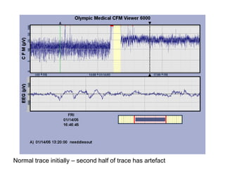 Normal trace initially – second half of trace has artefact
 