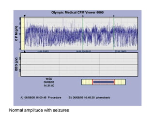 Normal amplitude with seizures
 