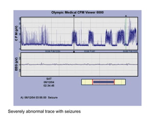 Severely abnormal trace with seizures
 