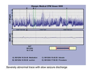 Severely abnormal trace with slow seizure discharge
 