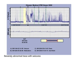 Severely abnormal trace with seizures
 