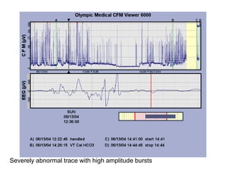 Severely abnormal trace with high amplitude bursts
 