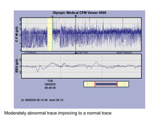 Moderately abnormal trace improving to a normal trace
 