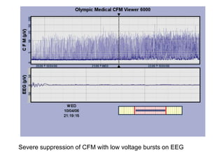 Severe suppression of CFM with low voltage bursts on EEG
 