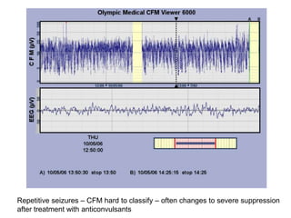 Repetitive seizures – CFM hard to classify – often changes to severe suppression
after treatment with anticonvulsants
 