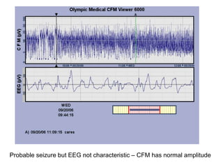 Probable seizure but EEG not characteristic – CFM has normal amplitude
 