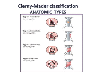 Cierny-Mader classification
ANATOMIC TYPES
 