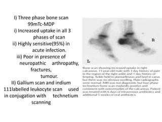 I) Three phase bone scan
99mTc-MDP
i) Increased uptake in all 3
phases of scan
ii) Highly sensitive(95%) in
acute infection.
iii) Poor in presence of
neuropathic arthropathy,
fractures,
tumour.
II) Gallium scan and indium
111labelled leukocyte scan used
in conjugation with technetium
scanning
 