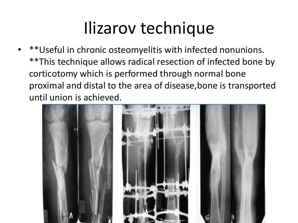 Osteomyelitis, acute, chronic,multifocal. classification, treatment